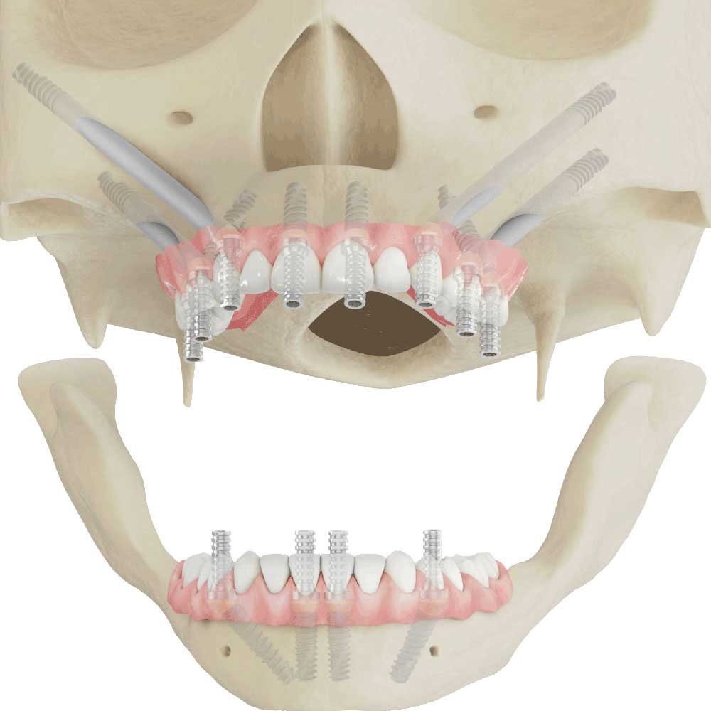 Zygomatic Implants Sedation and Implant Dentists