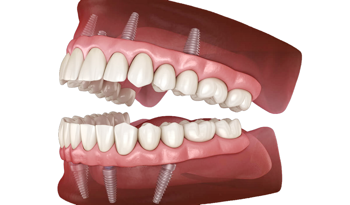 Full Mouth Implants Sedation and Implant Dentists